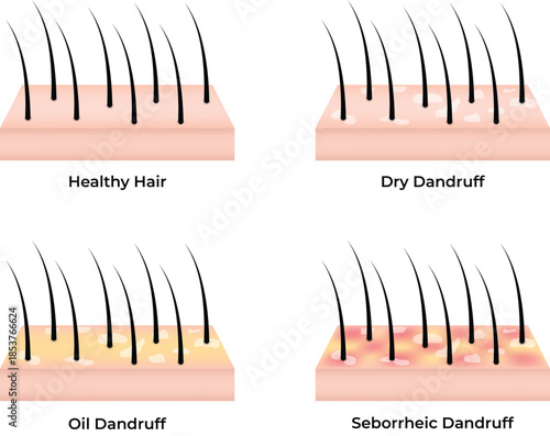 Scalp Conditions Healthy Hair Dry Oily and Seborrheic Dandruff Comparison vector illustration