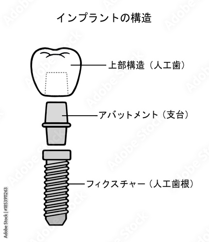 インプラントの構造のイラスト - 2