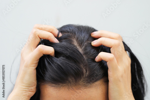 Fotografie A woman has problems with hair and scalp,she has dandruff from allergic reactions to shampoos