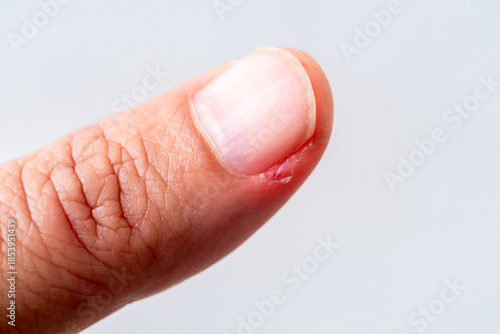 Foto Human fingernail with redness and minor wound around the cuticle, showing nail infection, hangnail irritation, or paronychia