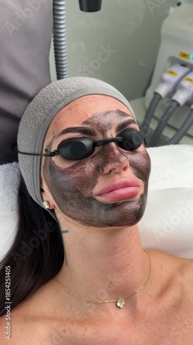 Young woman getting carbon laser facial at beauty clinic. Professional skincare treatment for deep pore cleansing, acne reduction and skin rejuvenation. Modern cosmetology procedure.