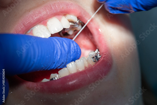 Tableau sur toile Keeping Smiles Bright During an Orthodontic Session With Careful Flossing and Pr
