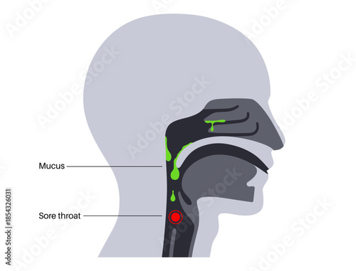Postnasal drip poster