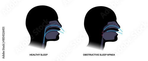Obstructive sleep apnea