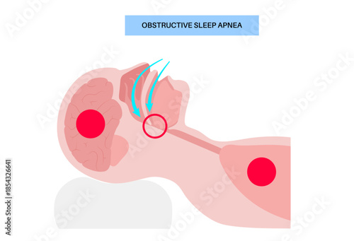 Obstructive sleep apnea