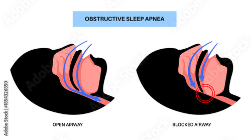 Obstructive sleep apnea
