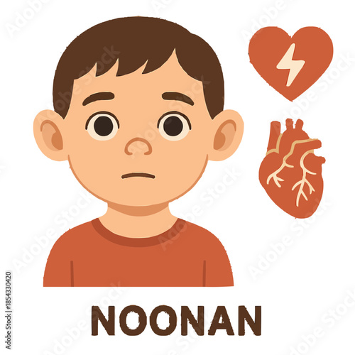 Noonan Syndrome Distinctive Facial Features Illustration