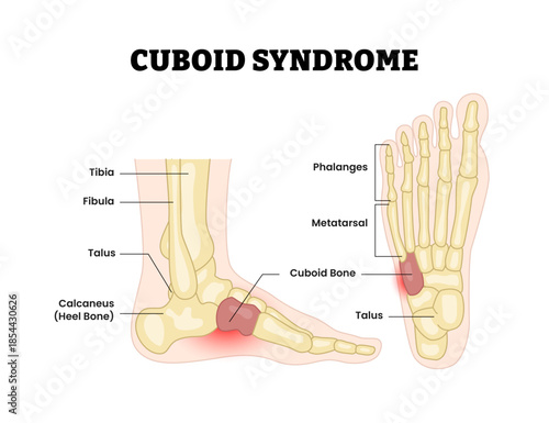 Cuboid syndrome as feet bone disorder condition. orthopedic trauma after foot torn injury. Cuboid subluxation problem. Feet bone dislocation. Medical education poster flat vector illustration.