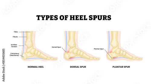 Different types of heel spurs types as feet bone disorder condition. Labeled normal, dorsal spur, plantar spur. Calcaneal bone condition. Medical education poster flat vector illustration.