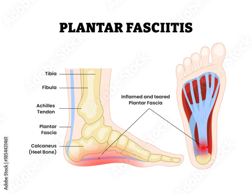 Plantar fasciitis as feet bone disorder condition. Heel bone, Inflammation Fascia muscle inflammation and tearing. Painful foot condition. Medical education poster flat vector illustration.