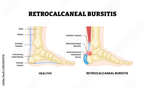 Retrocalcaneal bursitis as feet bone disorder condition. Ankle achilles tendon bursa. ligament or achilles tendon retrocalcaneal pain. Medical education poster flat vector illustration.