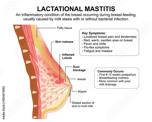 Lactational Mastitis Breast Illustration Medical Flashcard