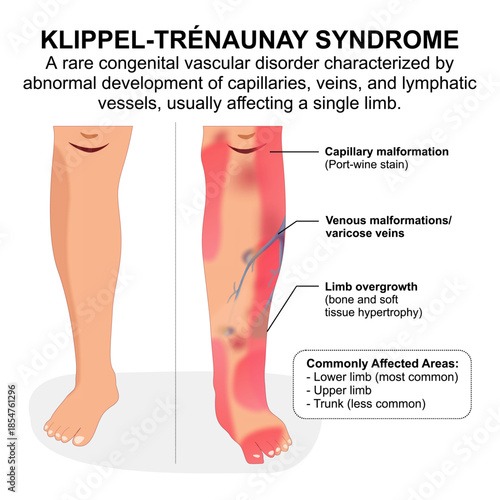 Klippel-Trenaunay Syndrome (KTS) Medical Flashcard
