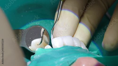 Dentist applying installing veneers. Doctor placing set of composite veneers on patient teeth. Dental care concept. Metal-ceramic crowns and bridges. closeup shot. Dentistry treatment, prosthetics of
