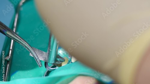 Dentist preparing oral cavity before installing veneers or dental crowns on sharpened teeth. closeup shot. Dental procedure video showing dentist expertly placing veneers. crowns on patient front