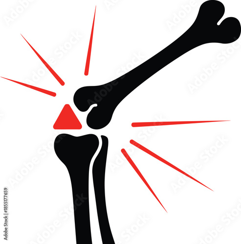Vector illustration of a human knee joint with red pain triangle and radiating lines, ideal for medical or orthopedic design use.