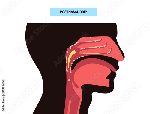 Postnasal drip poster