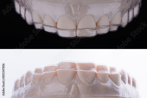 Vacuum-pressed dental template for gum correction fixed on model on black and white background.