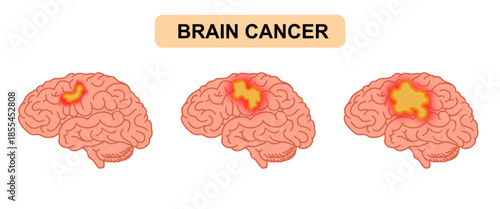 Brain tumor illustration. Human brain cancer, glioma, tumor in human brain tissue. Cancer cell structure. Vector illustration for medical, scientific, and educational purposes.