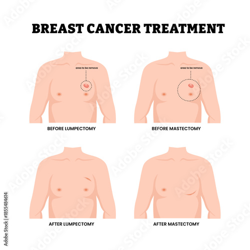 Different types of breast cancer surgery treatment types. Labeled before after lumpectomy and mastectomy. Area to be removed.
