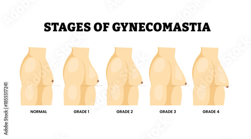 Stages of Gynecomastia stages. Male breast enlargement progression from normal size to fourth grade. Hormonal imbalance condition. Benign enlargement of breast tissue in males. Excess glandular size.
