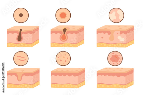 Skin layer cross-sections illustrating various dermatological conditions