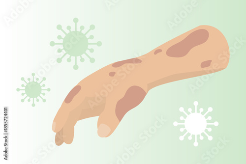 Leprosy disease concept. World leprosy day. Flat vector illustration.