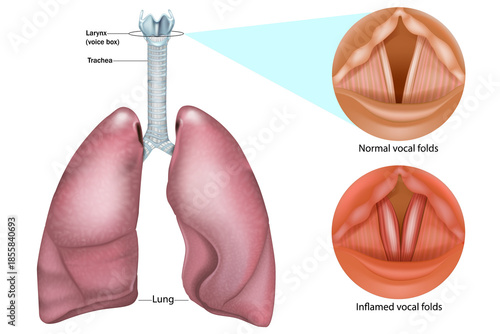 Human respiratory system with larynx, trachea, and lungs. Normal and inflamed vocal folds. Anatomical differences between healthy vocal folds and inflammation associated with laryngitis, voice disorde
