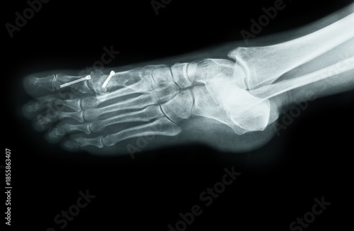 Картината върху платно X-ray of the front foot after Hallux Valgus surgery sideview black background cl