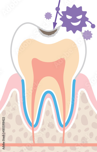 虫歯の進行度の図解