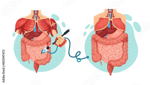 Comparison of human digestive system before and after colon cleansing procedure