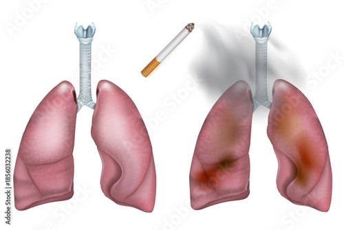 Healthy Lungs and Smoking Damaged Lungs Comparison Medical Illustration. Effects of Cigarette Smoking on Human Lungs Anatomy Illustration