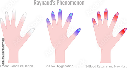 Raynaud's phenomenon disease steps. Resulting in areas turning white, blue or red. Cold hands syndrome. usually fingers and toes. Condition that causes blood vessels. Vector illustration