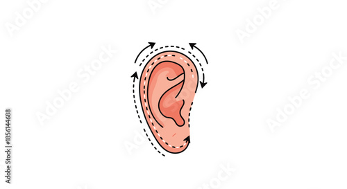 Medical illustration showing the process of otoplasty or ear surgery, with dotted lines and arrows indicating the cosmetic procedure.