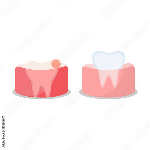 Flat-style illustration of baby teething process. Swollen, red, and painful gum before tooth eruption.
