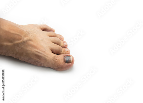 Close up of black toenail (Subungual hematoma) caused by running or sport injury isolated on white background.