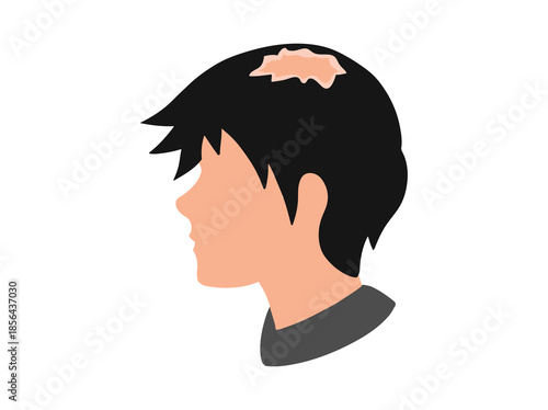 Hand Drawn Lichen Planus Disease
