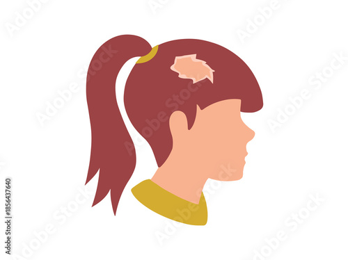 Lichen Planus Disease in Hair