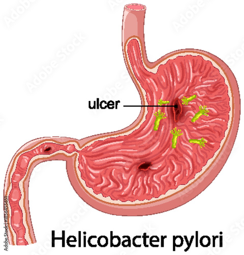 Helicobacter Pylori Bacteria Causing Stomach Ulcer Illustration