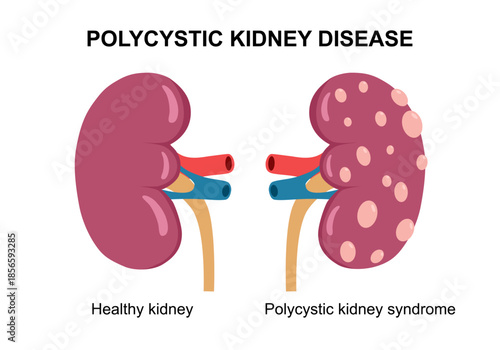 Kidney cysts polycystic urinary disease. Renal cysts of fluid in the kidneys. Medical diagram