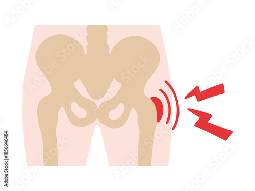 Bursitis Trocanteric Disease in Hip
