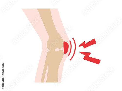 Bursitis Prepatellar Disease in Knee
