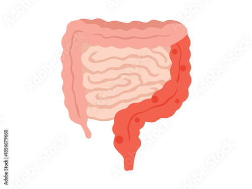 Colitis Disease in Intestines or Intestinal Colon 
