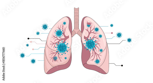 Medical diagram of human lungs infected with the coronavirus, showing the virus spreading through the respiratory system.