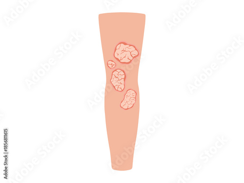 Plaque Psoriasis Disease in Elbows Skin