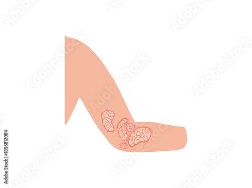 Plaque Psoriasis Disease in Elbows Skin