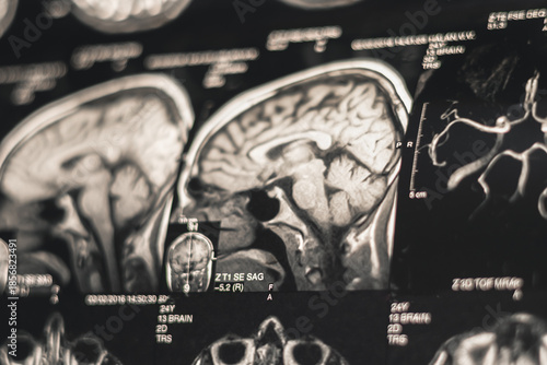 A doctor examines an X-ray of a human brain. Treatment head diseases. Close up.