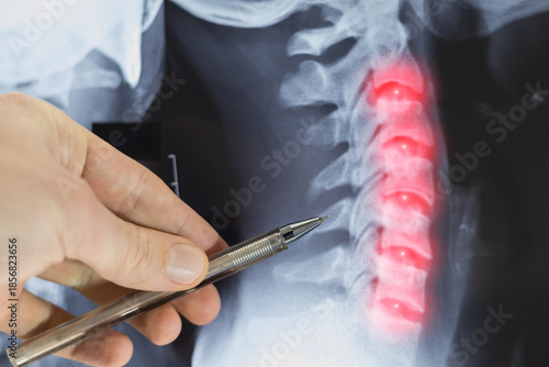 A doctor examines an X-ray of a human neck spine. Close up.
