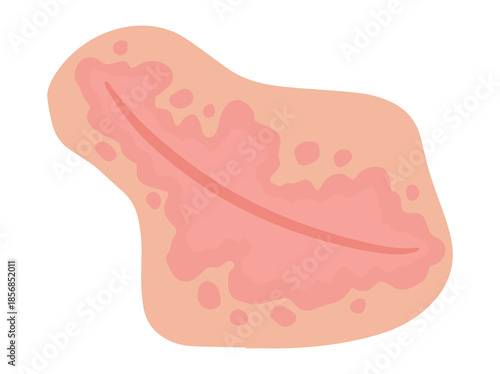 Hand Drawn Inverse Psoriasis Disease in Skin
