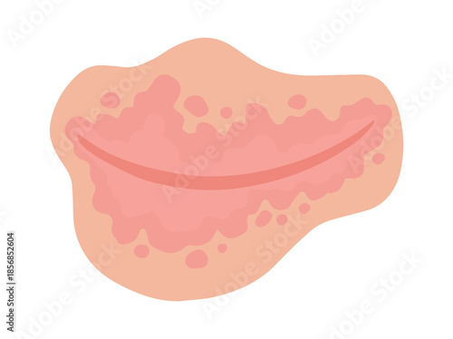 Inverse Psoriasis Disease in Skin Illustration
